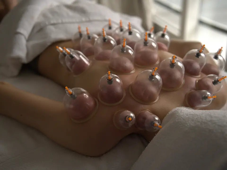 Cupping therapy cups on the back during a massage at home in Dubai
